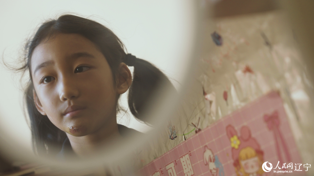 Parut yang tertinggal pada dagu Sun Xiaoxiao. (Foto oleh Qiu Yuzhe)